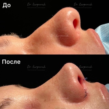 До и после ринопластики. Хирург Сергей Карпович