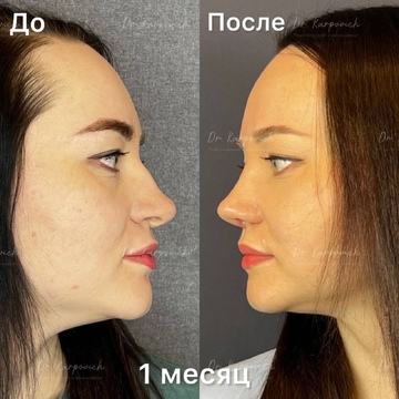 До и после ринопластики. Хирург Сергей Карпович