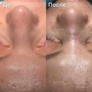 До и после. Ринопластика / риносептопластика. Доктор Сергей Карпович