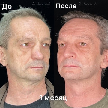 До и после ринопластики. Хирург Сергей Карпович