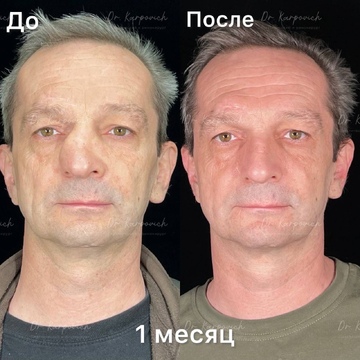 До и после. Ринопластика / риносептопластика. Доктор Сергей Карпович