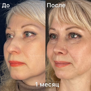 До и после ринопластики. Хирург Сергей Карпович