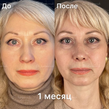 До и после. Ринопластика / риносептопластика. Доктор Сергей Карпович