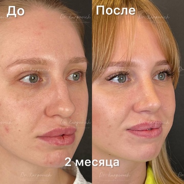 До и после. Ринопластика / риносептопластика. Доктор Сергей Карпович