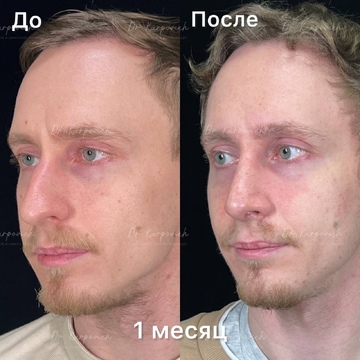 До и после. Ринопластика / риносептопластика. Доктор Сергей Карпович