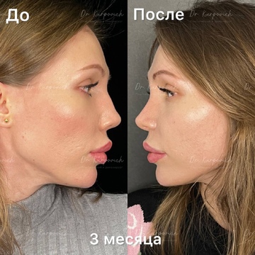 До и после ринопластики. Хирург Сергей Карпович