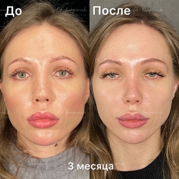 До и после. Ринопластика / риносептопластика. Доктор Сергей Карпович