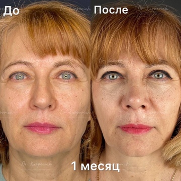 До и после. Ринопластика / риносептопластика. Доктор Сергей Карпович
