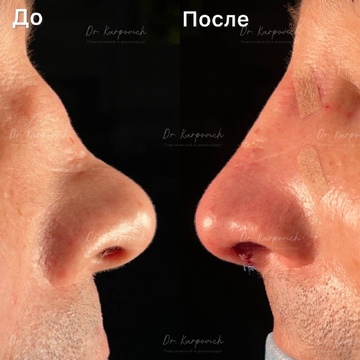 До и после ринопластики. Хирург Сергей Карпович