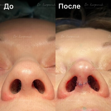 До и после. Ринопластика / риносептопластика. Доктор Сергей Карпович