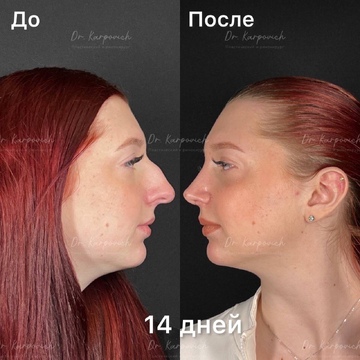 До и после ринопластики. Хирург Сергей Карпович