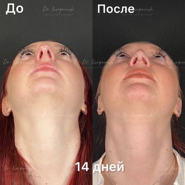 До и после. Ринопластика / риносептопластика. Доктор Сергей Карпович
