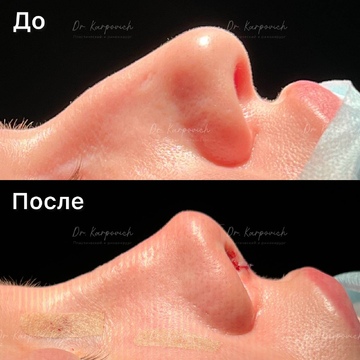 До и после ринопластики. Хирург Сергей Карпович