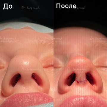 До и после. Ринопластика / риносептопластика. Доктор Сергей Карпович