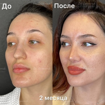 До и после ринопластики. Хирург Сергей Карпович