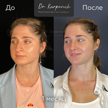 До и после ринопластики. Хирург Сергей Карпович