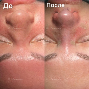 До и после. Ринопластика / риносептопластика. Доктор Сергей Карпович
