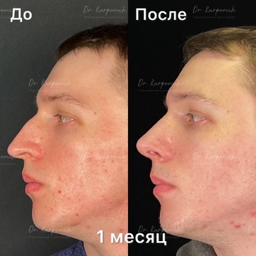 До и после ринопластики. Хирург Сергей Карпович
