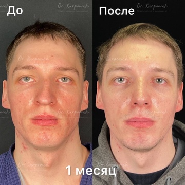 До и после. Ринопластика / риносептопластика. Доктор Сергей Карпович