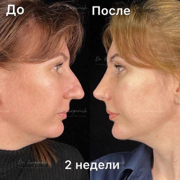 До и после ринопластики. Хирург Сергей Карпович