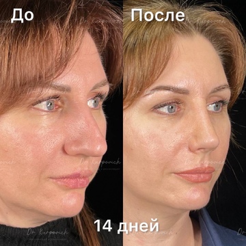 До и после. Ринопластика / риносептопластика. Доктор Сергей Карпович