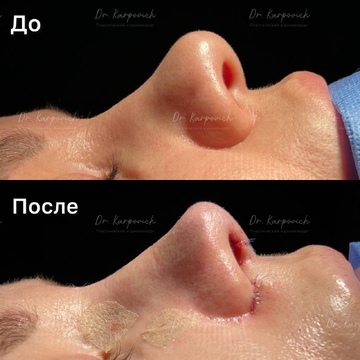До и после ринопластики. Хирург Сергей Карпович