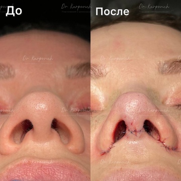 До и после. Ринопластика / риносептопластика. Доктор Сергей Карпович
