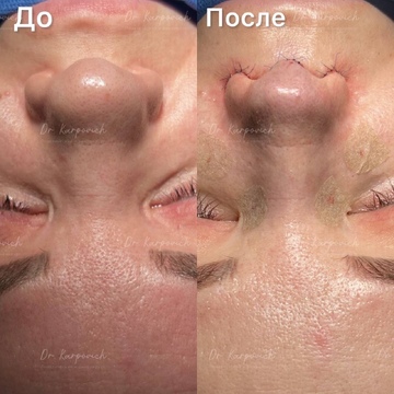 До и после. Ринопластика / риносептопластика. Доктор Сергей Карпович