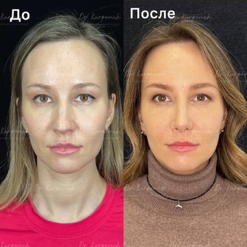 До и после. Ринопластика / риносептопластика. Доктор Сергей Карпович