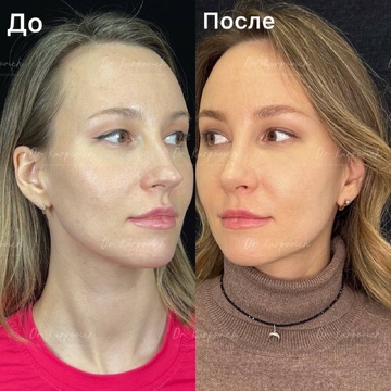 До и после. Ринопластика / риносептопластика. Доктор Сергей Карпович