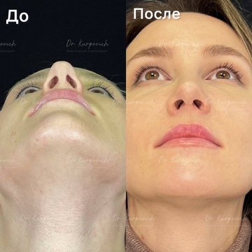 До и после. Ринопластика / риносептопластика. Доктор Сергей Карпович