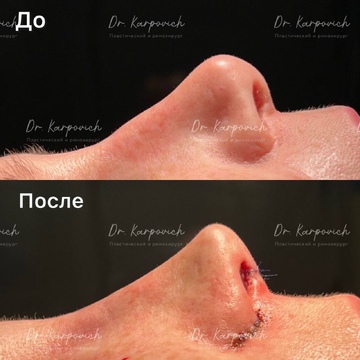 До и после ринопластики. Хирург Сергей Карпович