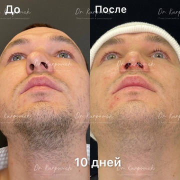 До и после. Ринопластика / риносептопластика. Доктор Сергей Карпович