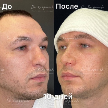 До и после. Ринопластика / риносептопластика. Доктор Сергей Карпович