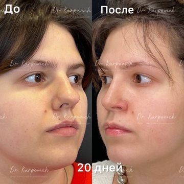 До и после. Ринопластика / риносептопластика. Доктор Сергей Карпович