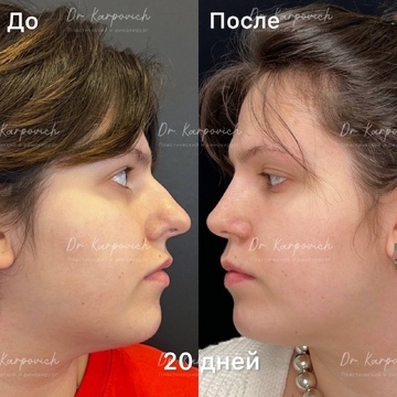 До и после ринопластики. Хирург Сергей Карпович