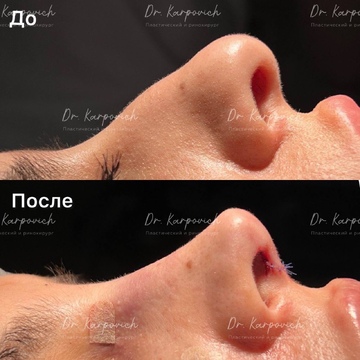 До и после ринопластики. Хирург Сергей Карпович