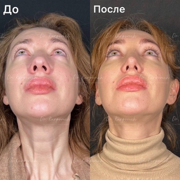 До и после. Ринопластика / риносептопластика. Доктор Сергей Карпович