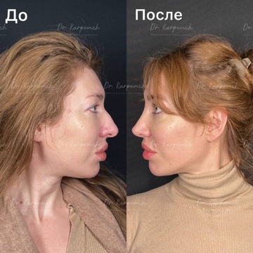 До и после ринопластики. Хирург Сергей Карпович
