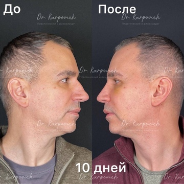 До и после ринопластики. Хирург Сергей Карпович