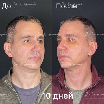 До и после. Ринопластика / риносептопластика. Доктор Сергей Карпович