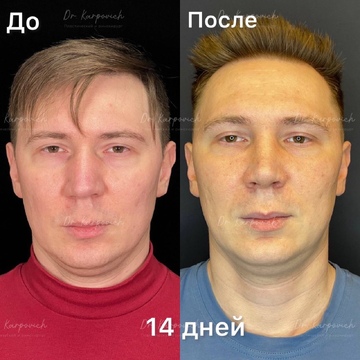 До и после. Ринопластика / риносептопластика. Доктор Сергей Карпович