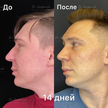 До и после ринопластики. Хирург Сергей Карпович
