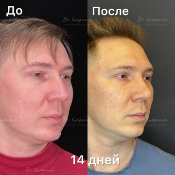 До и после. Ринопластика / риносептопластика. Доктор Сергей Карпович