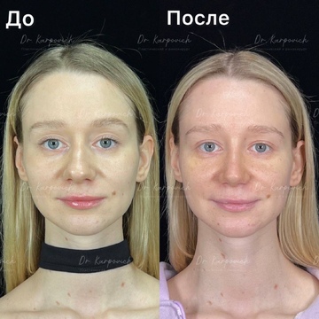 До и после. Ринопластика / риносептопластика. Доктор Сергей Карпович