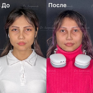 До и после. Ринопластика / риносептопластика. Доктор Сергей Карпович