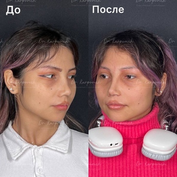 До и после. Ринопластика / риносептопластика. Доктор Сергей Карпович