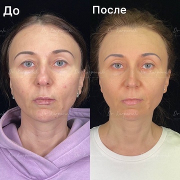 До и после. Ринопластика / риносептопластика. Доктор Сергей Карпович