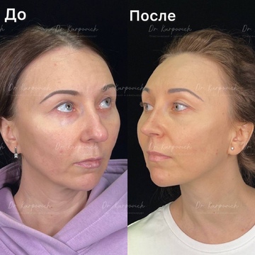 До и после. Ринопластика / риносептопластика. Доктор Сергей Карпович