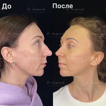До и после ринопластики. Хирург Сергей Карпович
